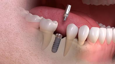 Single implant video