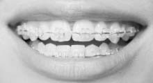 Ceramic Braces