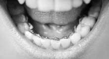 Lingual Braces