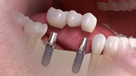 Multiple dental implants