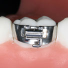 Brace bracket