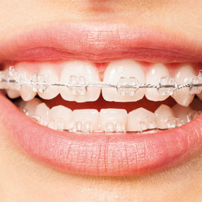 Ceramic braces