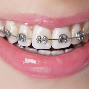 Fixed metal braces